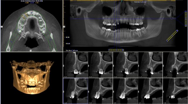 Dental-CT zur Planung kieferorthopädische Behandlung bei Zahnfehllage