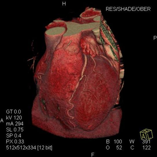 Oberflächenbildrekonstruktion einer Cardio CT mit Darstellung der Herzkranzgefäße