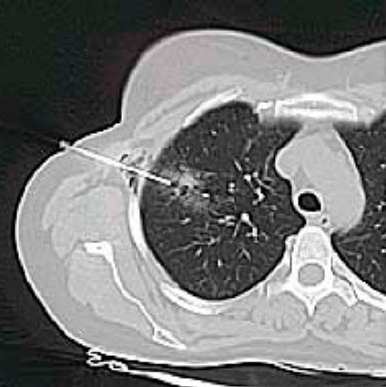 Tumor der Lunge