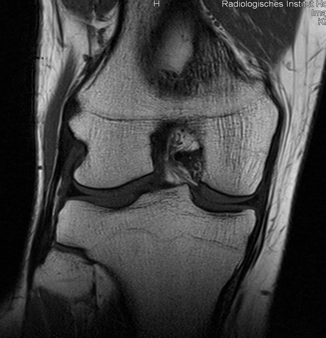 Koronare MRT eines Kniegelenkes