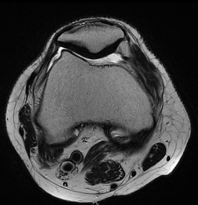 Axiale MRT eines Kniegelenkes