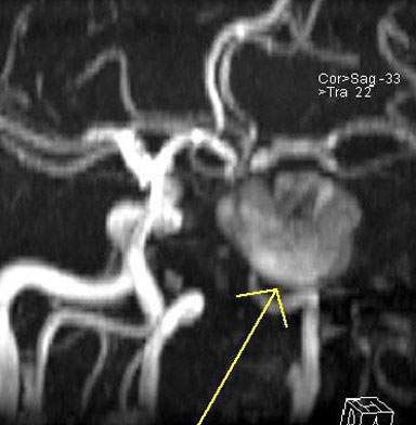 MR-Angiografie – Aneursma der a. carotis interna links (Pfeil)