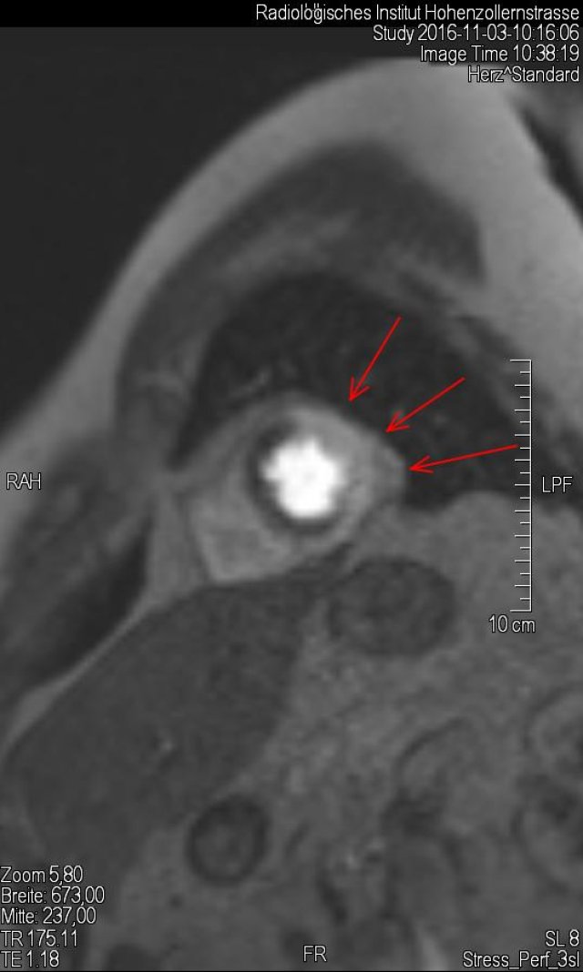 Durchblutungsstörung unter Belastung (medikamentös) im Versorgungsgebiet der linken Coronararterie